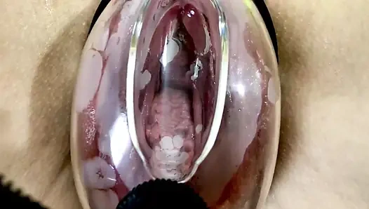 Vakum pompasının etkisi altında vajinal deformasyon