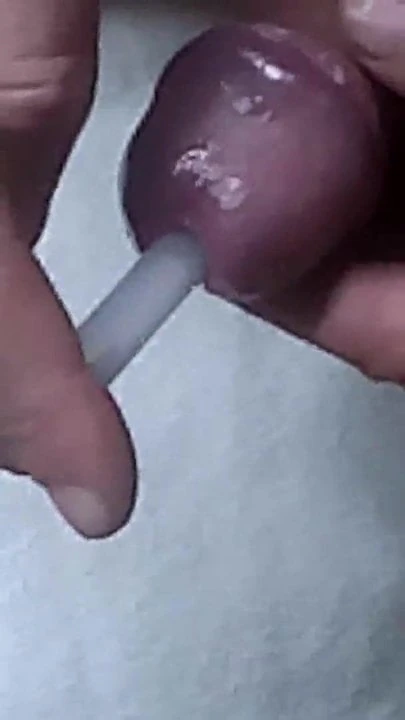 Ampul ve yapıştırıcı üretraya yapışır