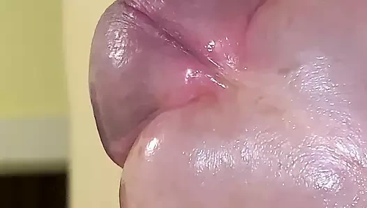 Fill the foreskin with saline until orgasm