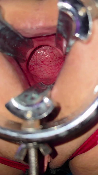 Extreme anal gape