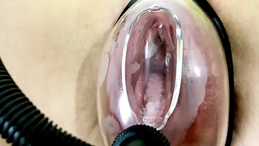 Vakum pompasının etkisi altında vajinal deformasyon