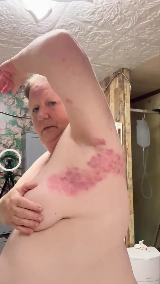 Bad Case of Shingles