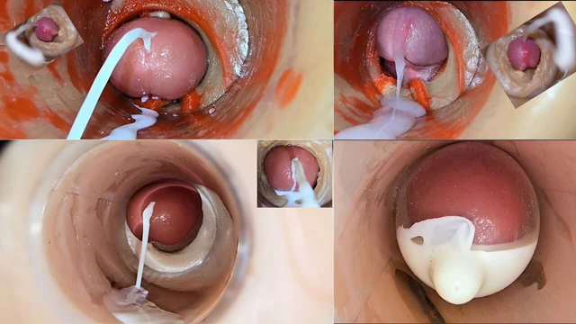 Dölleme damlayan dölleme derlemesi- endoskopi görünümü