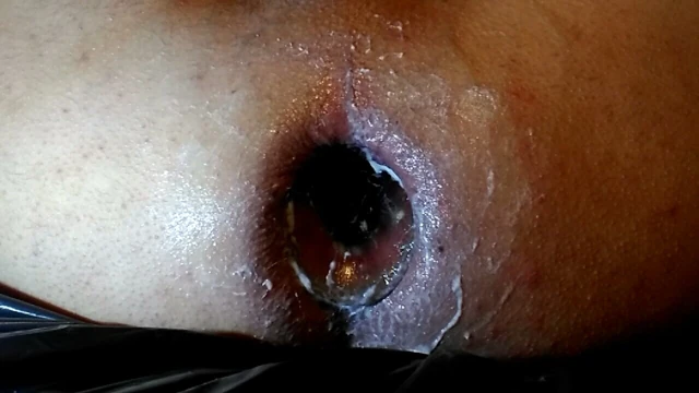 dilatasyon anal