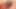 Rosebud prolapse anal esnetildikten sonra ıslak dışarı çıkıyor
