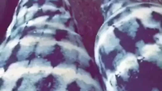 Protez bacak #2 ile Sak ampute