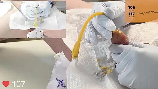 20 Fransız foley kateter sokma