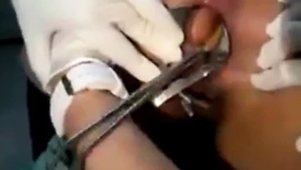 Cirurgia para retirada de brinquedo erotico do cu