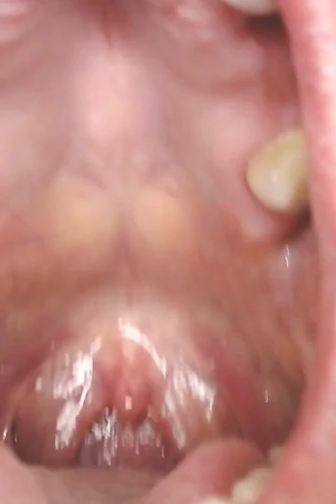 Gırtlağına ve ağzına tükürük ipleri olan Üveula Tonsils