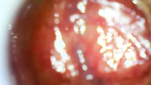 Usb endoskop 80 cm derin anal yerleştirme