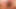 Rosebud prolapse anal esnetildikten sonra ıslak dışarı çıkıyor