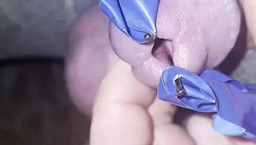 Mum ağdası işeme deliği ekleme