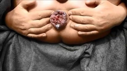 Hemoroid anal prolapsus doktor gyn