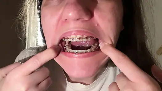 Dilinizle diş teli yalamak