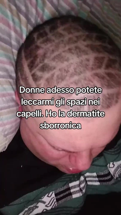 Tik tok ustası dermatit hastası