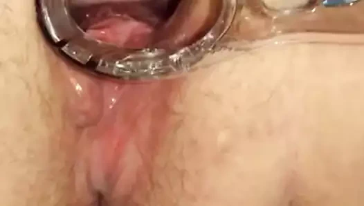 anal açıldı ile spekulum