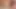 Dilatation anale 1