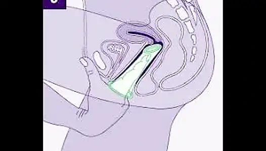 Don't use the wrong way Condom Use Mistakes (Hindi)