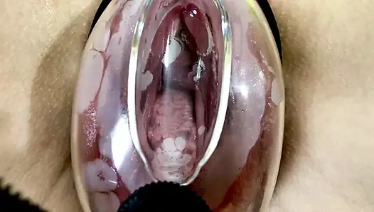 Vakum pompasının etkisi altında vajinal deformasyon