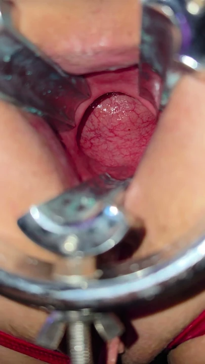 Extreme anal gape