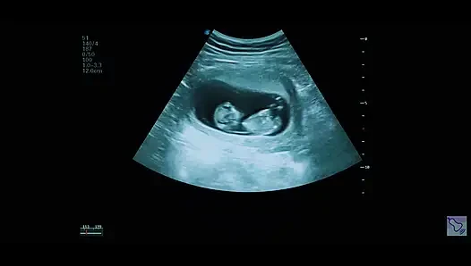 Hamile ve depresyonda: ultrason ve DNA kanıtı. Duygusal Bakış