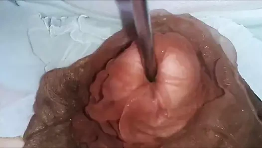 üretramda naylon insert ile Cum