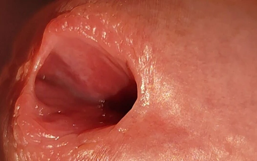 Bir Penis Başı Deliği Nasıl aşırı Derecede Genişletilir.