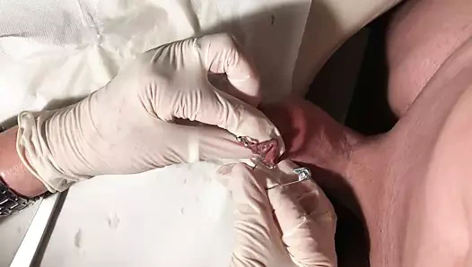 sünnet derisi kapatma