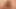 Rosebud prolapse anal esnetildikten sonra ıslak dışarı çıkıyor