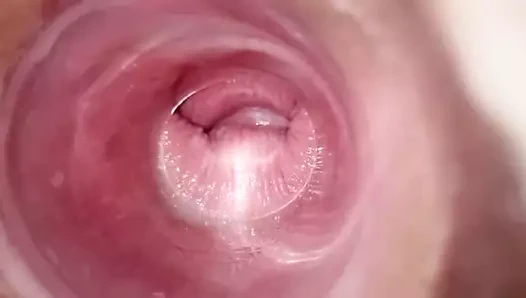 Şeffaf fişle oynama – serviks görünümü