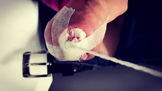 çiş sünnet derisi germe