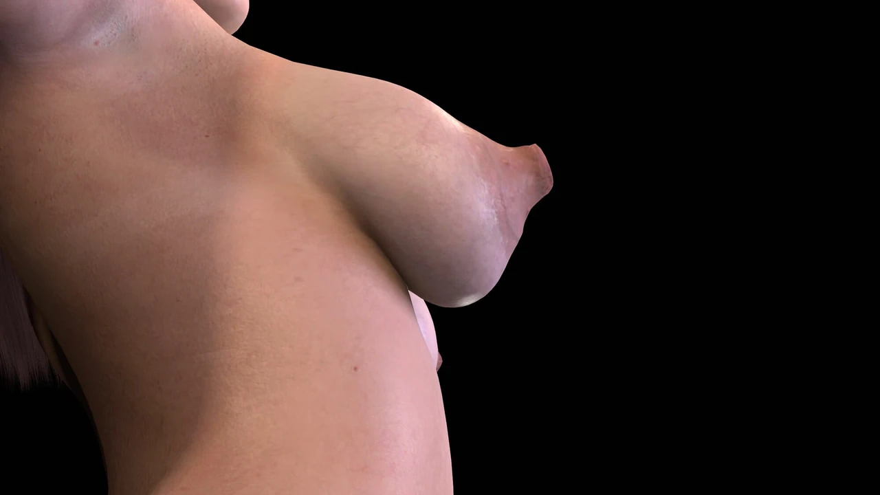 Расширение груди -, превью