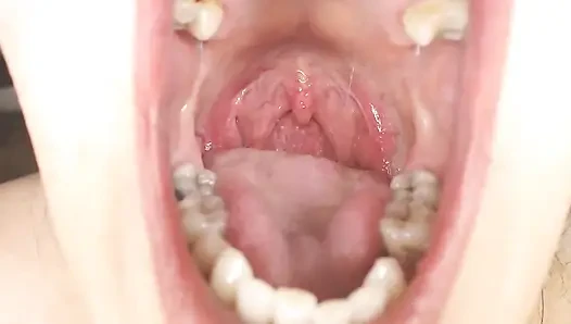 Gırtlağına ve ağzına tükürük ipleri olan Üveula Tonsils