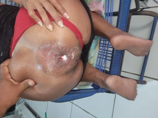 Anal prolapsop, o göt deliği senin gibileri hak ediyor