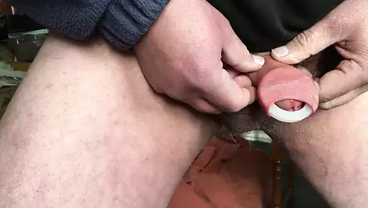 Plastik halkalı sünnet derisi