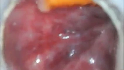 Anal derin ekleme endoskop içeride