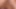Derin, anal itiş, genişletme, sarkma ve fışkırtma