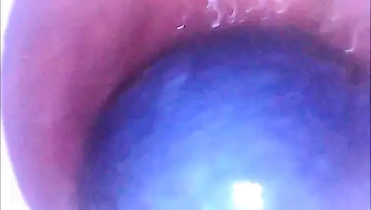 Kıçım 2 Çin topunu ve 2 bilardo topunu yutuyor