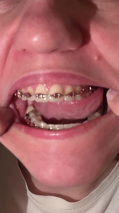 Dilinizle diş teli yalamak