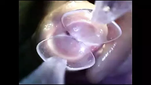 Endoskop 2 kaşıkla üretranın içine itin horoz keşfi