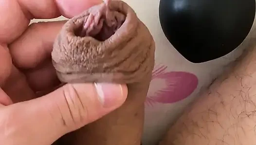 Aşırı sünnet derisi pompalama