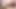Aşırı anal prolapsus - web kamerasında karısı