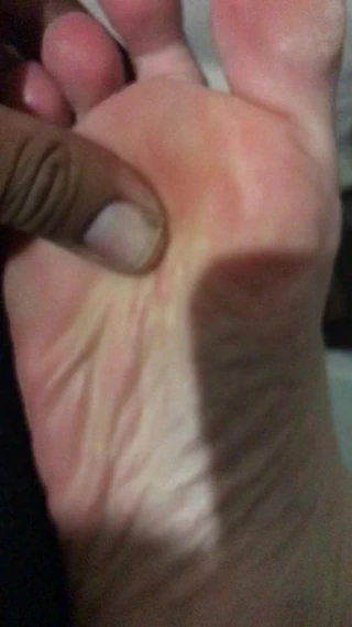 Ayak parmaklarının arasında koku