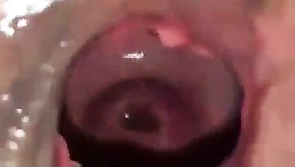 1 derin göt genişletme