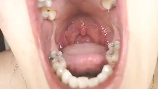 Gırtlağına ve ağzına tükürük ipleri olan Üveula Tonsils