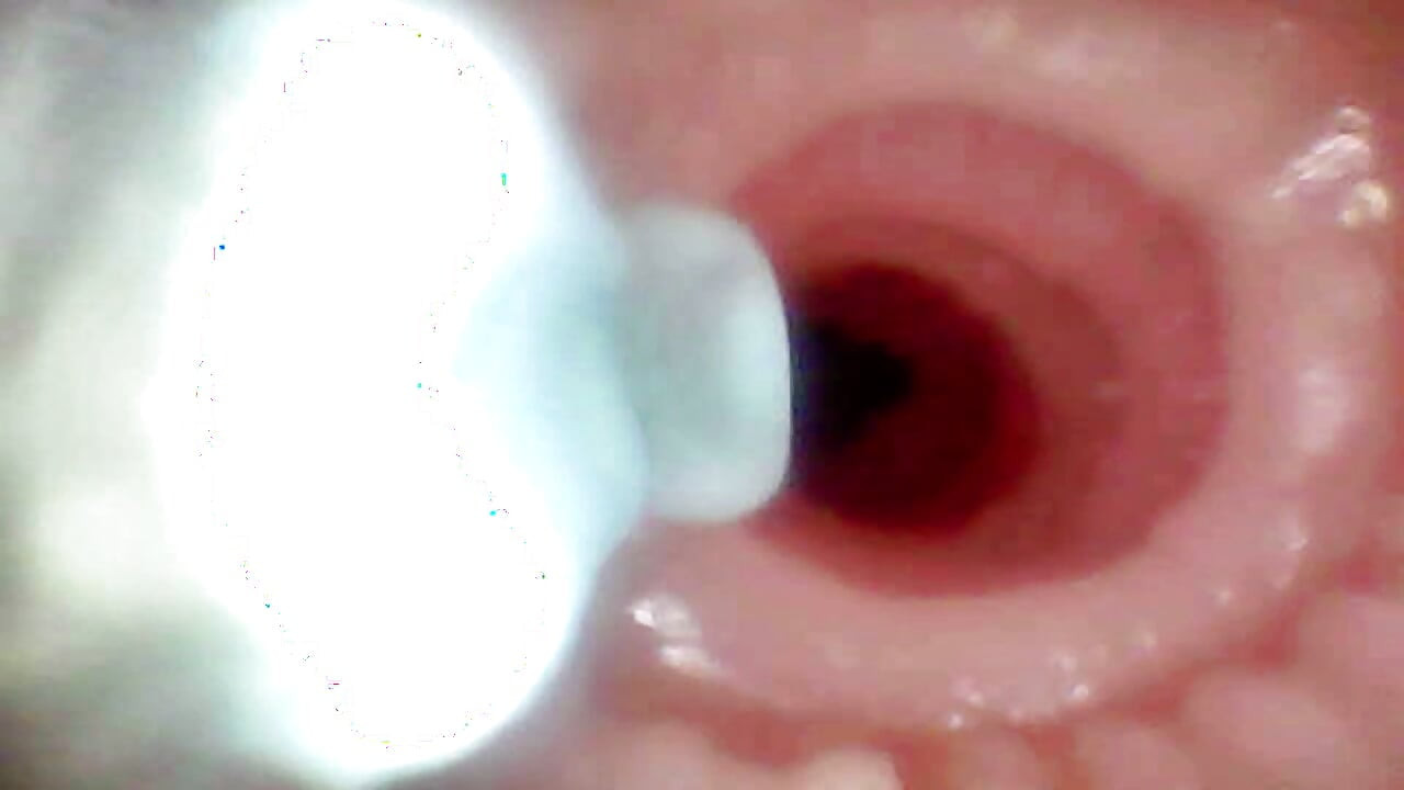 Endoskop kamera kullanarak lopuza93 ağız boşluğu ve anal bölgenin ayrıntılı muayenesi.