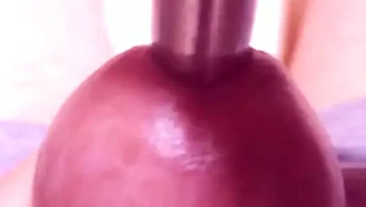 Üretral dilatasyon sondaj bujisi 12.5mm çapında. giriş çıkış