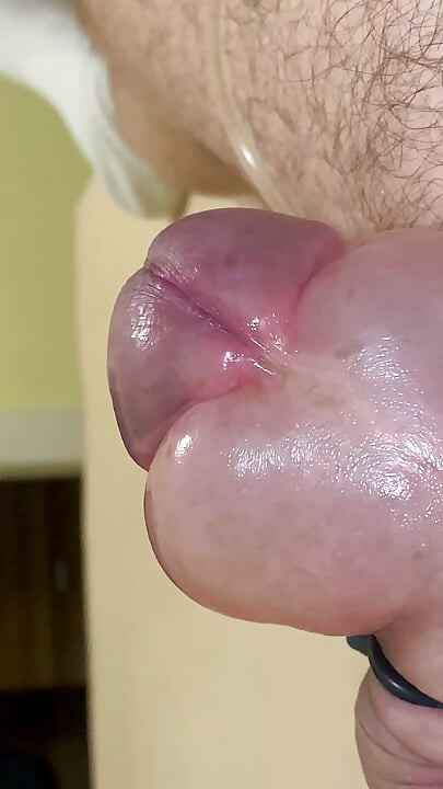 Fill the foreskin with saline until orgasm