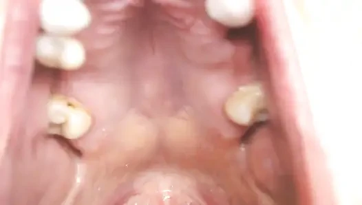 Gırtlağına ve ağzına tükürük ipleri olan Üveula Tonsils