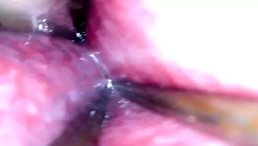 Geniş açık üretraya derinlemesine bakış - bölüm 1